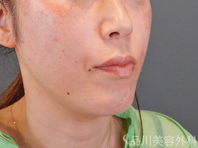 症例NO.75296のAFTER写真