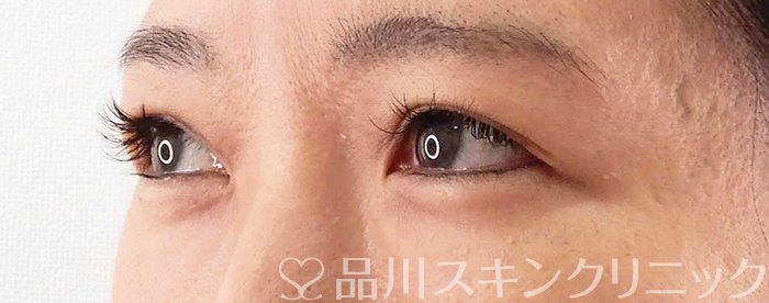 症例NO.67862のBEFORE写真