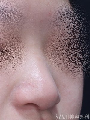 症例NO.71041のBEFORE写真