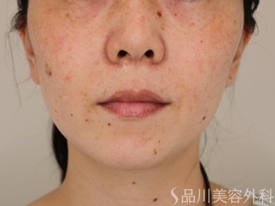 症例NO.74173のAFTER写真