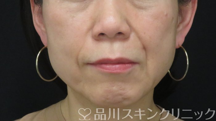 症例NO.72197のBEFORE写真