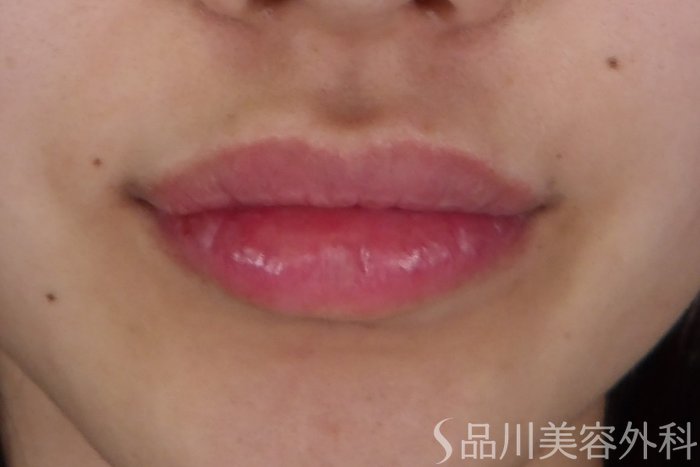 症例NO.69683のAFTER写真