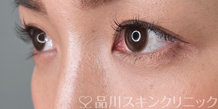 症例NO.70040のAFTER写真
