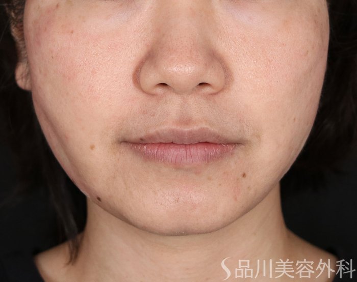 症例NO.73715のAFTER写真