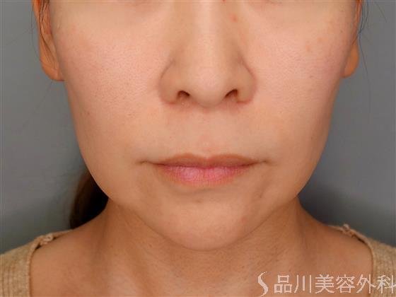 症例NO.53287のBEFORE写真