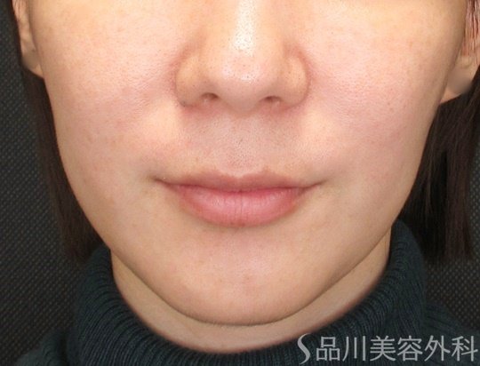 症例NO.69672のBEFORE写真