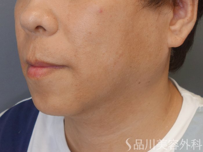 症例NO.72071のBEFORE写真