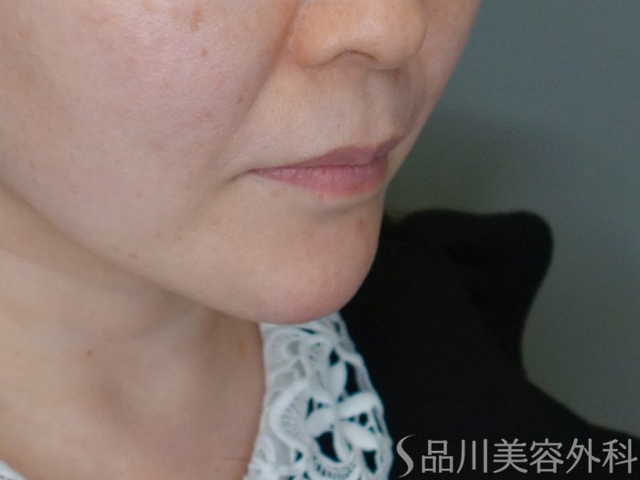 症例NO.69435のAFTER写真