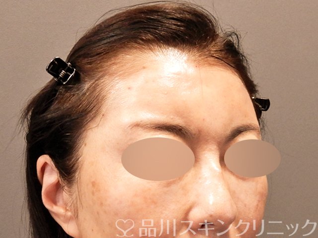 症例NO.71084のAFTER写真