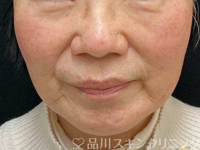 症例NO.73538のBEFORE写真