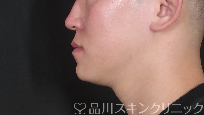 症例NO.72442のAFTER写真