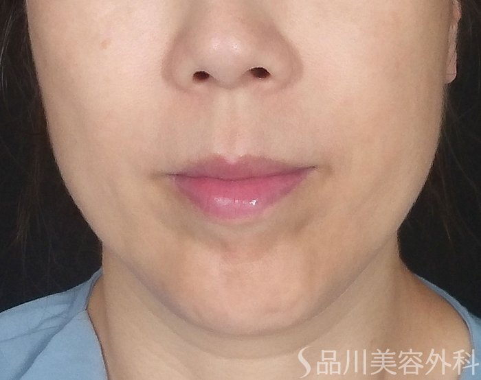症例NO.65345のBEFORE写真