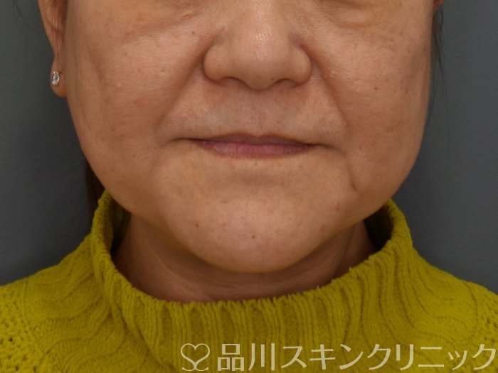 症例NO.74734のBEFORE写真