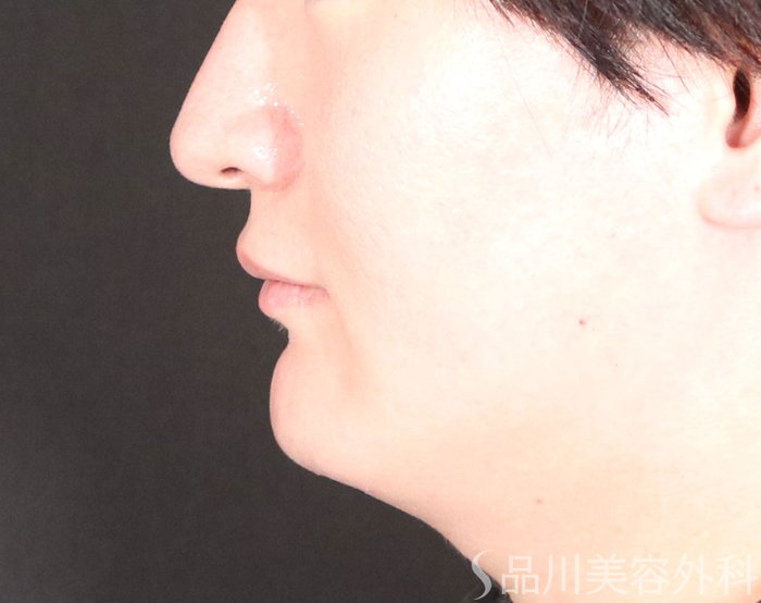 症例NO.74071のAFTER写真