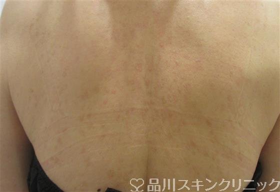 症例NO.32811のAFTER写真