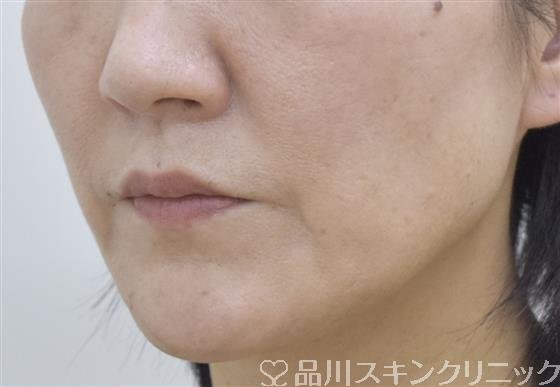 症例NO.53432のBEFORE写真