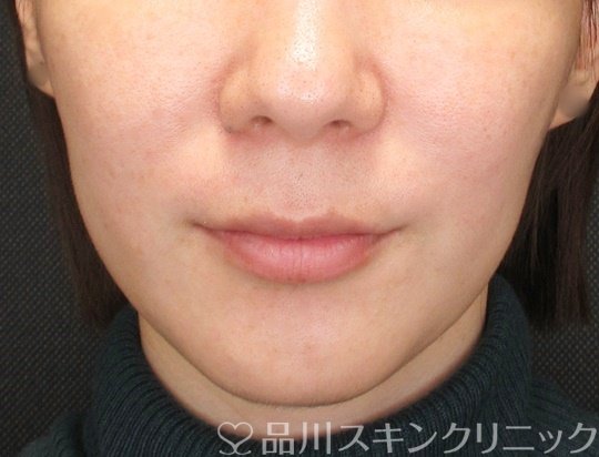 症例NO.69672のBEFORE写真