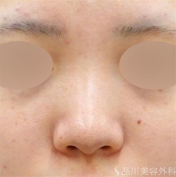 症例NO.48770のBEFORE写真