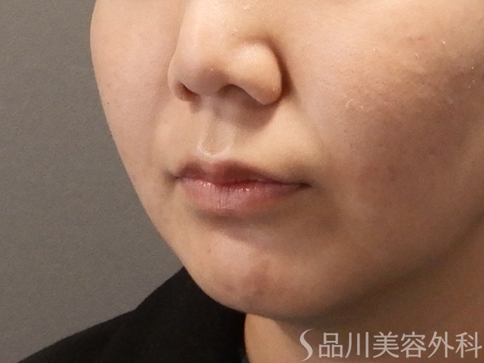 症例NO.67988のBEFORE写真