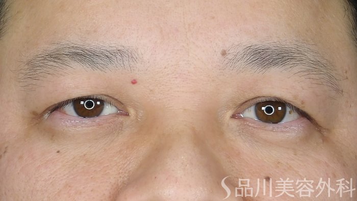 症例NO.70527のBEFORE写真