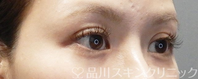 症例NO.72991のAFTER写真