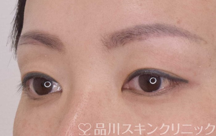 症例NO.64103のBEFORE写真