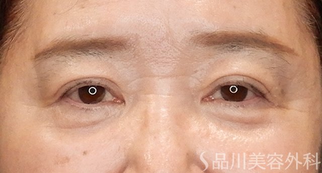 症例NO.75353のAFTER写真
