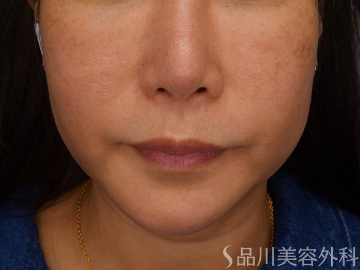 症例NO.75335のBEFORE写真