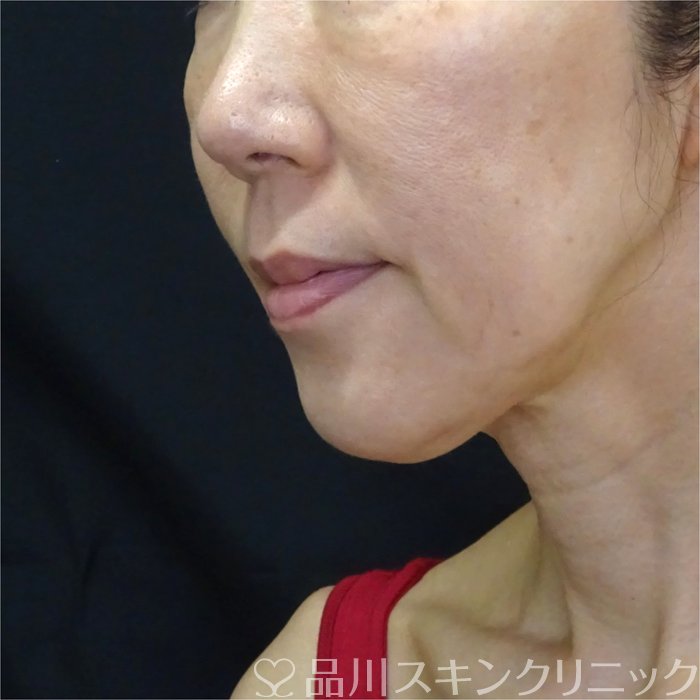 症例NO.71173のBEFORE写真
