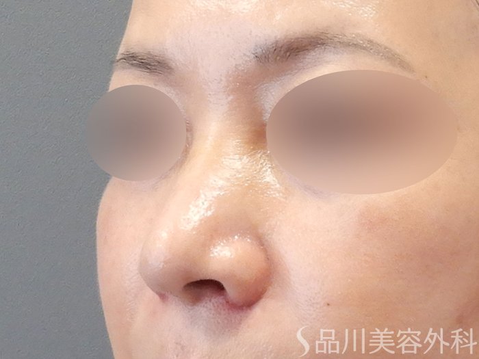 症例NO.70618のAFTER写真