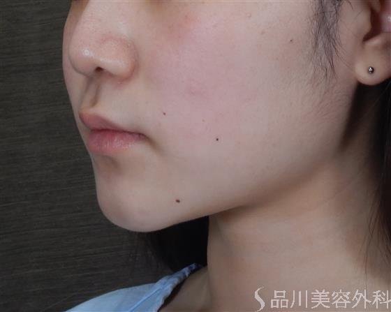 症例NO.60338のBEFORE写真