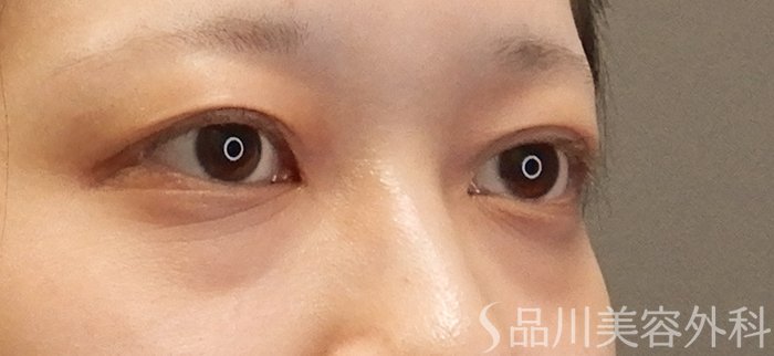 症例NO.71450のBEFORE写真