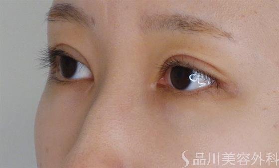 症例NO.52942のAFTER写真