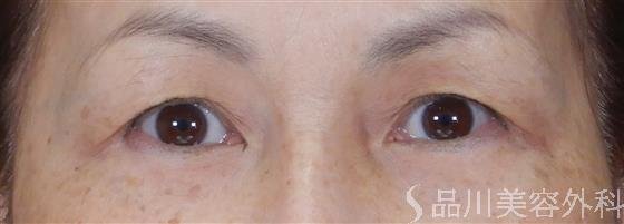 症例NO.59613のBEFORE写真