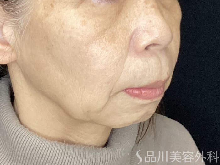 症例NO.72092のBEFORE写真