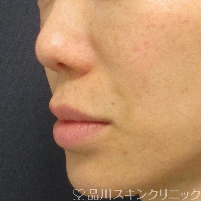 症例NO.74245のBEFORE写真