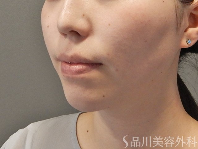 症例NO.75130のBEFORE写真