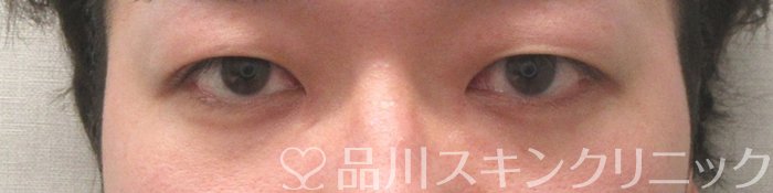 症例NO.74410のBEFORE写真