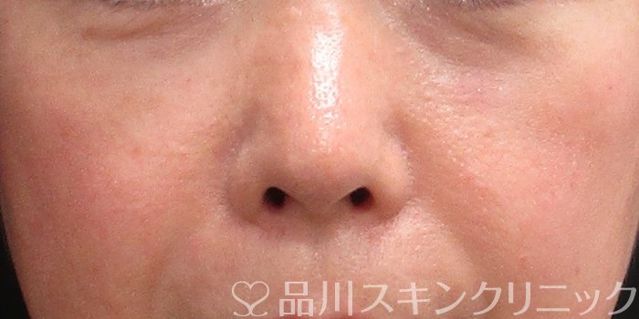 症例NO.73201のBEFORE写真