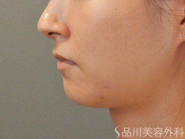 症例NO.71816のBEFORE写真