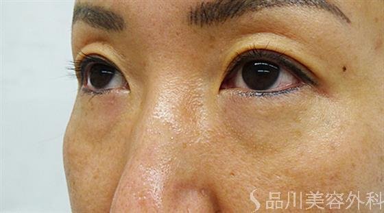 症例NO.44609のBEFORE写真