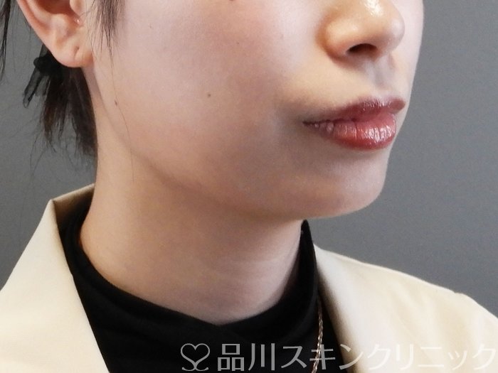 症例NO.64247のBEFORE写真