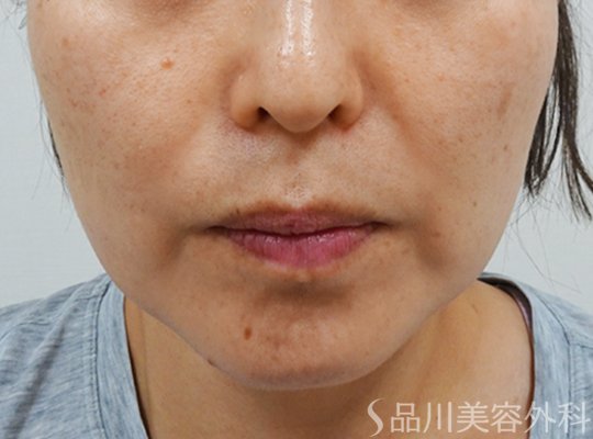 症例NO.73393のBEFORE写真