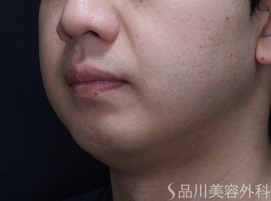 症例NO.72147のBEFORE写真