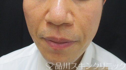 症例NO.69680のAFTER写真