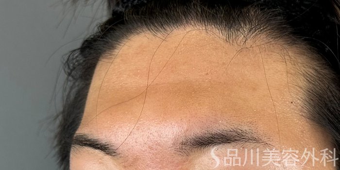 症例NO.71128のBEFORE写真