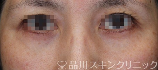 症例NO.64149のAFTER写真