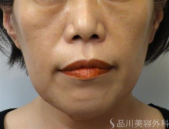 症例NO.40037のBEFORE写真