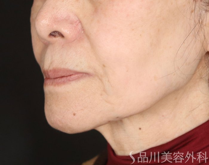 症例NO.72997のBEFORE写真