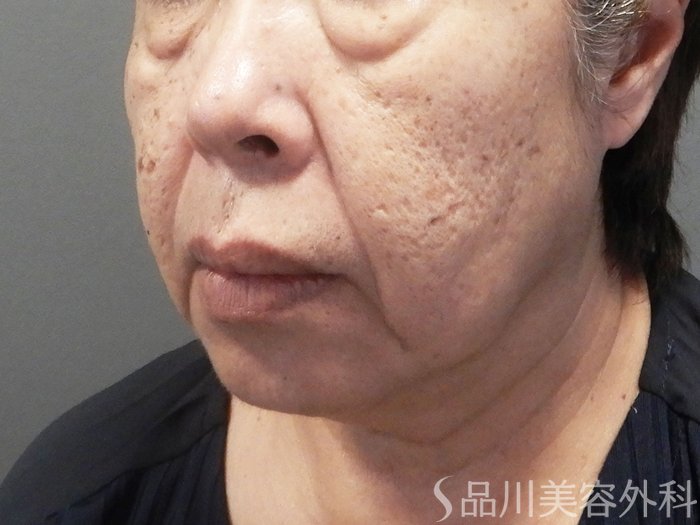 症例NO.70857のBEFORE写真